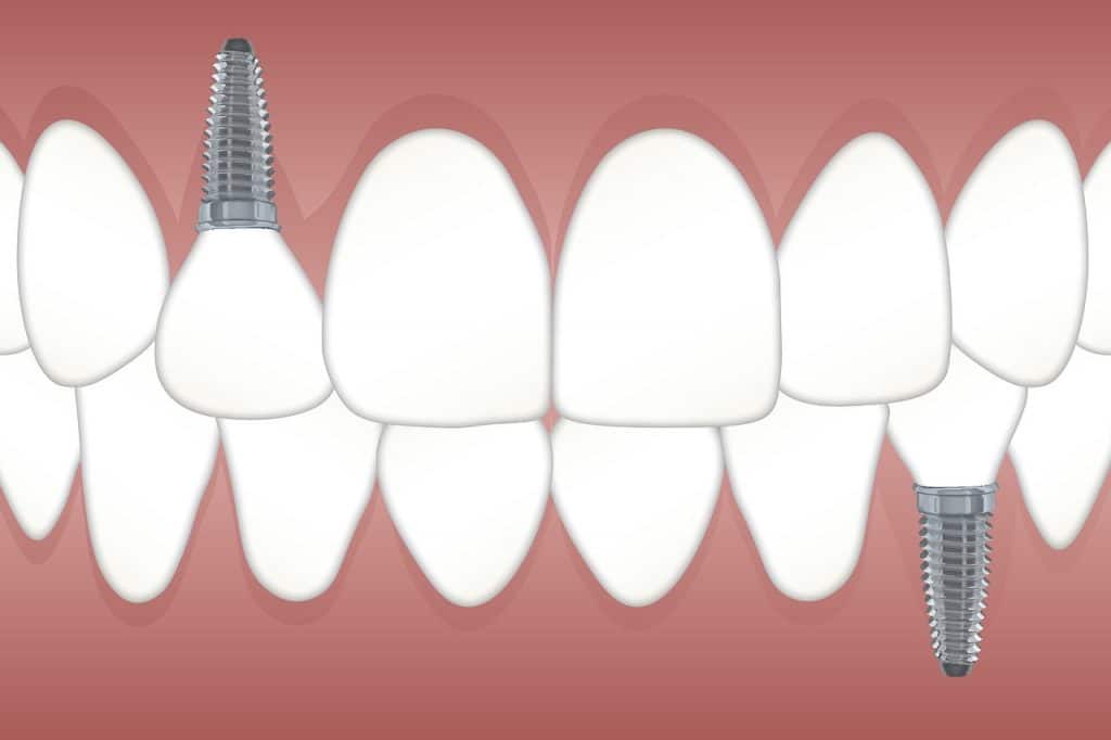 שיניים מושתלות 